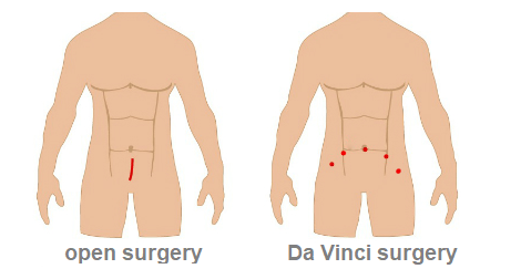 Open vs. Da Vinci prostatectomy