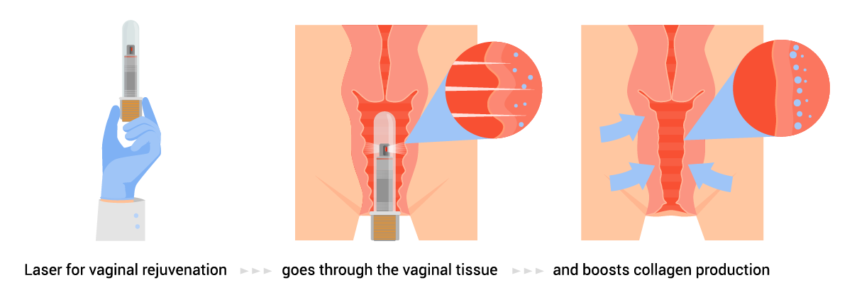 laser_vaginoplasty