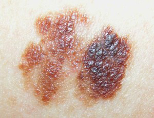 Superficial melanoma images