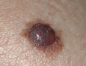 nodular melanoma images