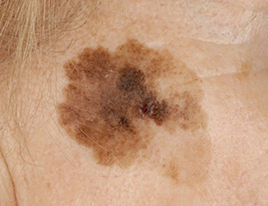 Lentigo melanoma image