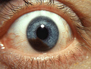 the eye melanoma image