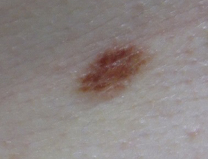 Dysplastic nevus and melanoma image