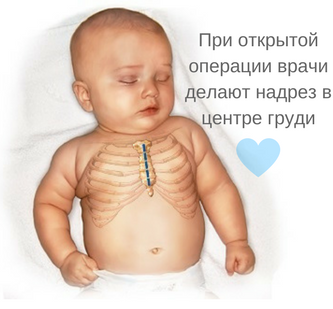 Операция на открытом сердце при врожденном пороке Операция на открытом сердце у ребенка, картинка
