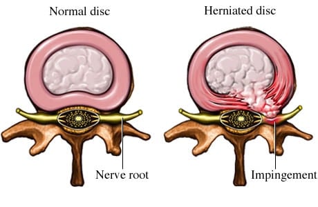Herniated disc treatment. Best clinics and affordable prices for therapy