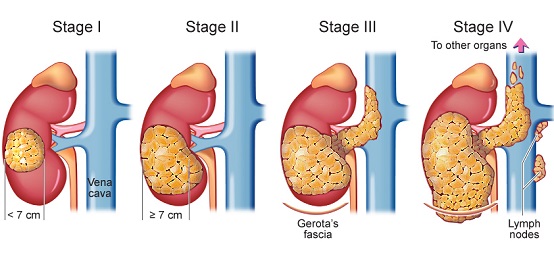 Staging of kidney cancer