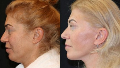 Augmentation before and after