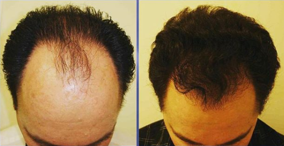 FUE transplant at Beverly Wilshire FUE transplant at Beverly Wilshire