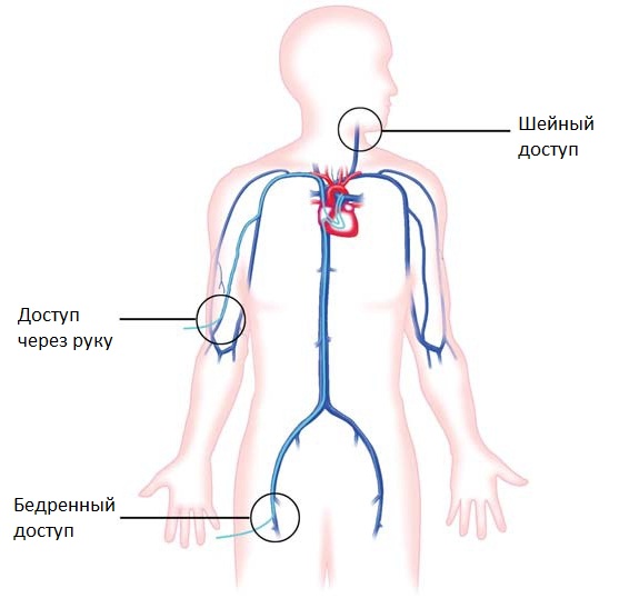 Эндоваскулярная операция на сердце ребенку Эндоваскулярная операция на сердце