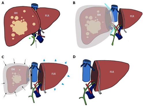 Liver resection varient