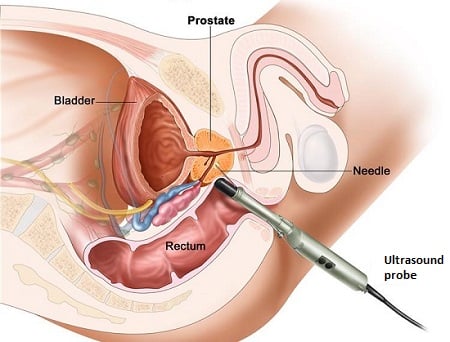 Prostate cancer biopsy