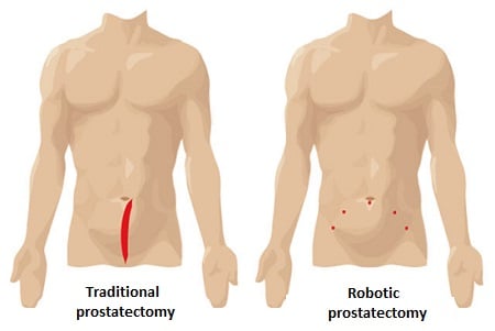 Traditional vs. robotic prostatectomy