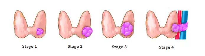 Thyroid cancer staging