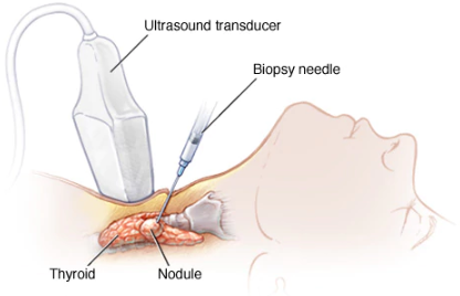 Thyroid cancer biopsy