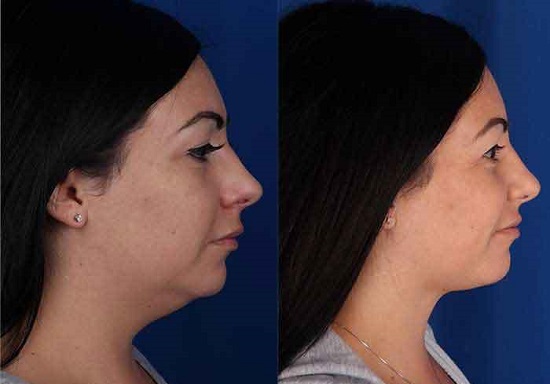 Liposuction: before and after