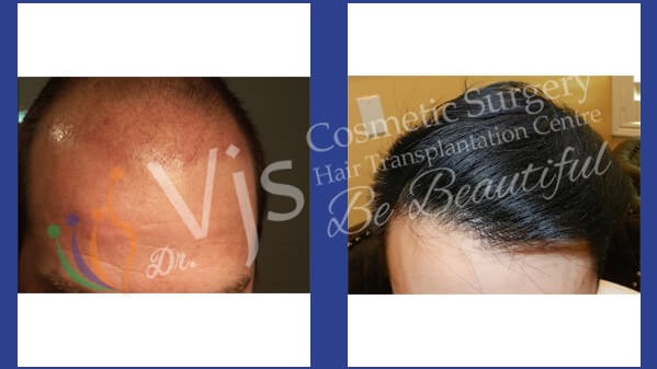 Before and after hair transplant in VJs clinic