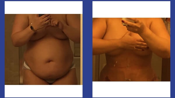 A patient's before-after liposuction photo at VJs