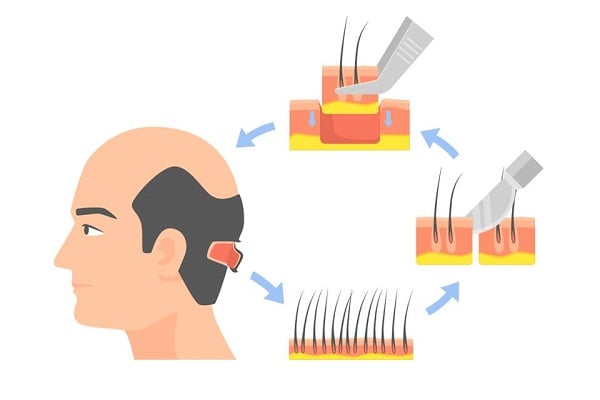 FUT hair transplant technique
